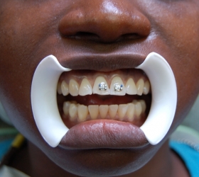 full mouth exposure 2