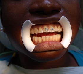 exposure to show teeth alignment