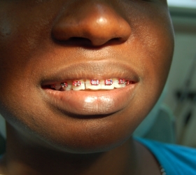 Alignment of teeth continue