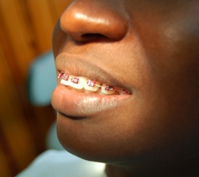Side view to show balance jaw line
