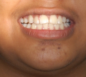 happy teenager with the prefect dental smile