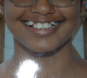 Little girl with an extreme case