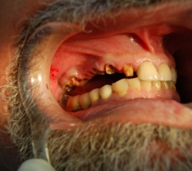 Close up of teeth before work is commenced