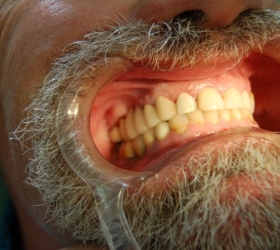 missing teeth replaced