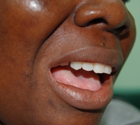 Discomfort of patient before solution applied