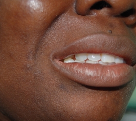 Tooth solution deployed