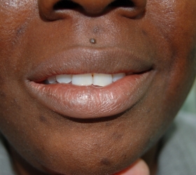 smiling patient