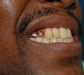 extreme middle stage